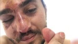 Georgian Civil Activist Bruised And Bloodied, Opposition's Homes, Offices Vandalized