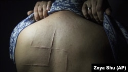  Світлина із фотопроєкту Зої Шу «Після полону»: колишній заручник угруповання «ДНР» Богдан Сергієць показує шрами, які залишились після того, як бойовики російських гібридних сил вирізали свастику на його спині. Фото 2019 року 