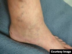 Сестра мобилизованного Сергея Полушкина Дарья съездила к нему в часть с сфотографировала его опухшие ноги, не влезающие в ботинки.